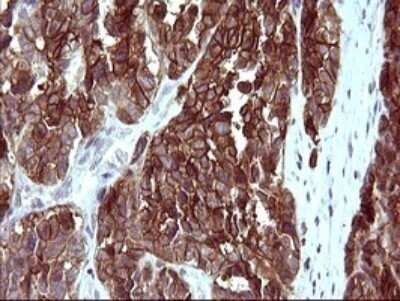 Immunohistochemistry: EpCAM/TROP1 Antibody (OTI1H9) - Azide and BSA Free [NBP2-71194] - Analysis of Adenocarcinoma of Human colon tissue. (Heat-induced epitope retrieval by 10mM citric buffer, pH6.0, 120C for 3min)