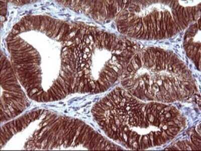 Immunohistochemistry: EpCAM/TROP1 Antibody (OTI1H9) - Azide and BSA Free [NBP2-71194] - Analysis of Adenocarcinoma of Human endometrium tissue. (Heat-induced epitope retrieval by 10mM citric buffer, pH6.0, 120C for 3min)