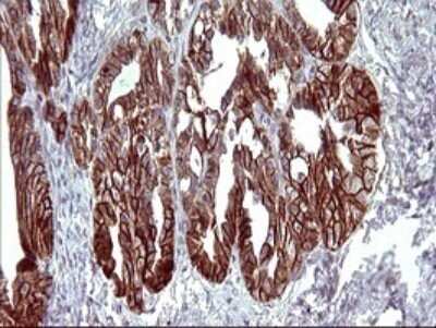 Immunohistochemistry: EpCAM/TROP1 Antibody (OTI1H9) - Azide and BSA Free [NBP2-71194] - Analysis of Adenocarcinoma of Human ovary tissue. (Heat-induced epitope retrieval by 10mM citric buffer, pH6.0, 120C for 3min)