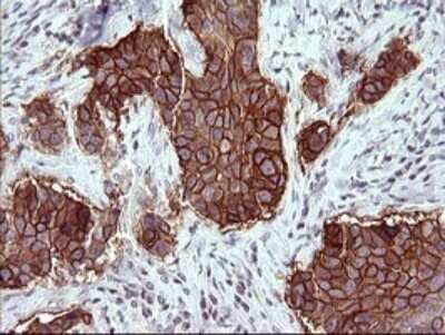 Immunohistochemistry: EpCAM/TROP1 Antibody (OTI1H9) - Azide and BSA Free [NBP2-71194] - Analysis of Carcinoma of Human lung tissue. (Heat-induced epitope retrieval by 10mM citric buffer, pH6.0, 120C for 3min)
