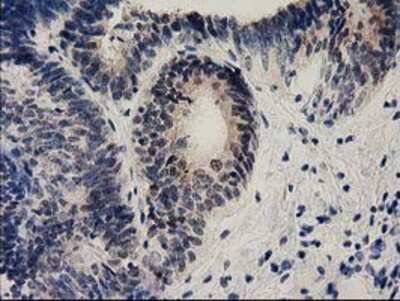 Immunohistochemistry-Paraffin: Ephrin A2 Antibody (3E3) [NBP2-02810] - Staining of paraffin-embedded Adenocarcinoma of Human endometrium tissue using anti-Ephrin A2 mouse monoclonal antibody.