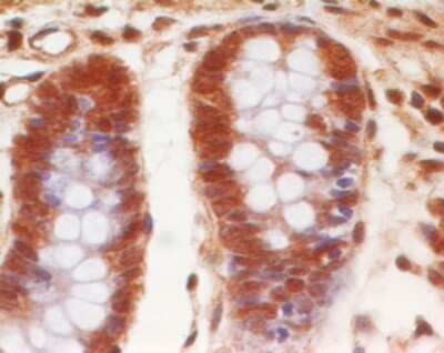 Immunohistochemistry-Paraffin: Eps8 Antibody (18F1F2) - Azide and BSA Free [NBP2-80723] - Formalin-fixed, paraffin-embedded human colon cancer stained with EPS8 antibody (5 ug/ml), peroxidase-conjugate and DAB chromogen. Image from the standard format of this antibody.