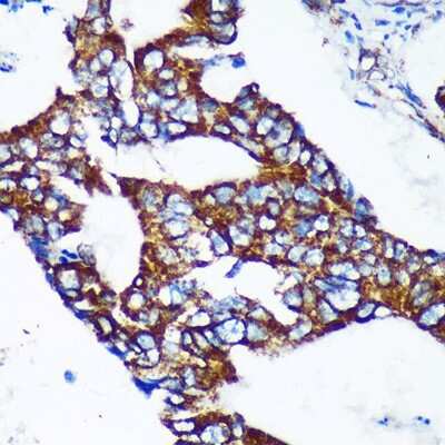 Immunohistochemistry-Paraffin: Epsin-2 Antibody [NBP3-03347] - Immunohistochemistry of paraffin-embedded Human colon carcinoma using Epsin-2 Rabbit pAb (NBP3-03347) at dilution of 1:100 (40x lens). Perform microwave antigen retrieval with 10 mM PBS buffer pH 7.2 before commencing with IHC staining protocol.