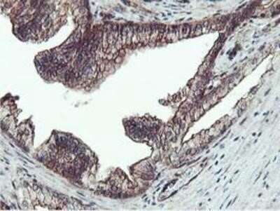 Immunohistochemistry: Epsin-2 Antibody (OTI1G3) - Azide and BSA Free [NBP2-71701] - Staining of paraffin-embedded Carcinoma of Human prostate tissue using anti-Epsin-2 mouse monoclonal antibody.