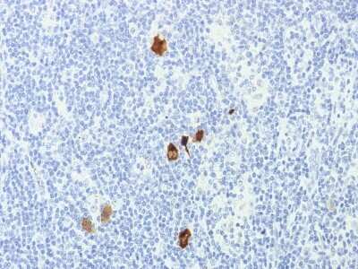 Immunohistochemistry-Paraffin: Epstein Barr Virus Antibody (CS1-4) - Azide and BSA Free [NBP3-08501] - Formalin-fixed, paraffin-embedded human Hodgkin's Lymphoma stained with Epstein Barr Virus Mouse Monoclonal Antibody (CS1-4).