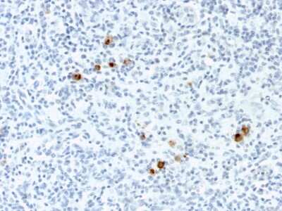 Immunohistochemistry-Paraffin: Epstein Barr Virus Antibody (CS4) - Azide and BSA Free [NBP3-08449] - Formalin-fixed, paraffin-embedded human Hodgkin's Lymphoma stained with Epstein Barr Virus Mouse Monoclonal Antibody (CS-4).