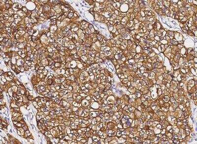 Immunohistochemistry-Paraffin: ErbB2/Her2 Antibody (002) [NBP2-89184] - Staining of human ERBB2 in human breast carcinoma with rabbit monoclonal antibody (1:200). 