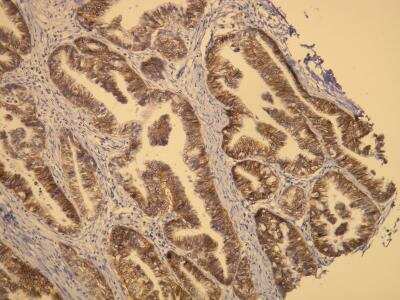Immunohistochemistry-Paraffin: ErbB2/Her2 Antibody (A24-V) [NBP1-79066] - ErbB2/Her2 protein expression (3+) in adenocarcinoma of stomach. Formalin fixed, paraffin embedded human tissues (4  um sections) stained with anti - ErbB2/Her2 monospecific antibody.