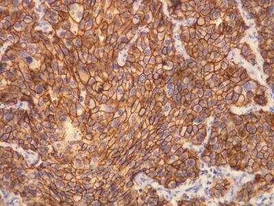 Immunohistochemistry-Paraffin: ErbB2/Her2 Antibody (A24-V) [NBP1-79066] - ErbB2/Her2 protein expression (3+) in breast ductal carcinoma. Formalin fixed, paraffin embedded human tissues (4  um sections) stained with anti - ErbB2/Her2 (DB 094) monospecific antibody according.