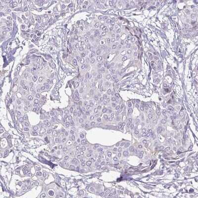 Immunohistochemistry-Paraffin: ErbB2/Her2 Antibody (CL0268) [NBP2-52896] - Staining of human HER2-negative breast cancer shows no positivity in tumor cells, as expected.