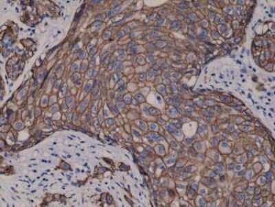 Immunohistochemistry-Paraffin: ErbB2/Her2 Antibody (RM228) [NBP2-61466] - Staining of FFPE humanbreast cancer tissue sections.
