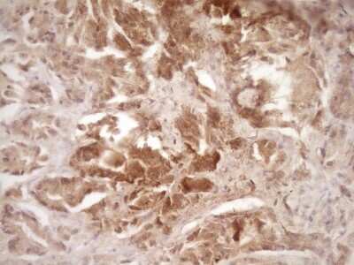 Immunohistochemistry: ErbB3/Her3 Antibody (OTI3E10) [NBP2-45481] - Analysis of Carcinoma of Human prostate tissue. (Heat-induced epitope retrieval by 1 mM EDTA in 10mM Tris, pH8.5, 120C for 3min)