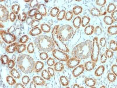 Immunohistochemistry-Paraffin: Erythropoietin/EPO Antibody (EPO/1367) [NBP2-53241] - Formalin-fixed, paraffin-embedded Human Renal Cell Carcinoma stained with Erythropoietin (EPO) Mouse Monoclonal Antibody (EPO/1367).