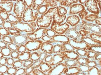 Immunohistochemistry-Paraffin: Erythropoietin/EPO Antibody (EPO/1368) [NBP2-53392] - Formalin-fixed, paraffin-embedded human Renal Cell Carcinoma stained with Erythropoietin/EPO Antibody (EPO/1368).