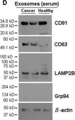 Western Blot: Exosome Detection (Western Blot) Antibody Pack [NBP3-11740] - Isolation and characterization of exosomes from cell culture supernatant and human blood. Immunoblot of exosomal markers CD81 (~30 kDa) using CD81 Antibody (NB100-65805), CD63 (~55 kDa), and LAMP2B (~50 kDa) in exosomes (5 ug lysates) isolated from the serum of breast cancer patients and healthy control. Grp94 (~100 kDa) and beta-actin (~42 kDa) serve as a negative control and a loading control, respectively. Image collected and cropped by CiteAb from the following publication (//www.nature.com/articles/srep36502), licensed under a CC-BY license.