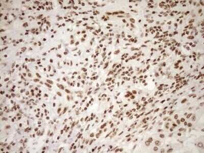 Immunohistochemistry: Exosome component 1 Antibody (OTI1H9) - Azide and BSA Free [NBP2-71895] - Analysis of Carcinoma of Human liver tissue.(Heat-induced epitope retrieval by 1mM EDTA in 10mM Tris buffer (pH8.5) at 120C for 3 min)