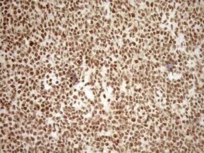 Immunohistochemistry: Exosome component 1 Antibody (OTI1H9) - Azide and BSA Free [NBP2-71895] - Analysis of Human lymphoma tissue. (Heat-induced epitope retrieval by 1mM EDTA in 10mM Tris buffer (pH8.5) at 120C for 3 min)