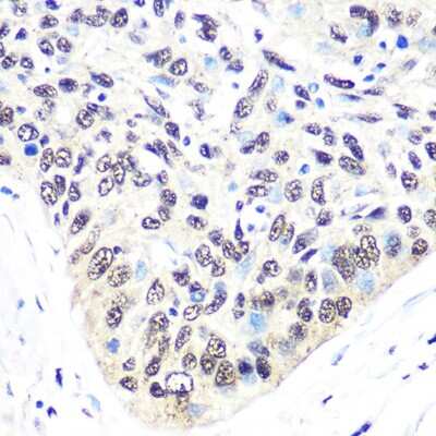 Immunohistochemistry-Paraffin: Exportin-5 Antibody (3Q8E6) [NBP3-16278] - Immunohistochemistry of paraffin-embedded human esophageal cancer using Exportin-5 (XPO5) Rabbit mAb (NBP3-16278) at dilution of 1:100 (40x lens).Perform microwave antigen retrieval with 10 mM PBS buffer pH 7.2 before commencing with IHC staining protocol.