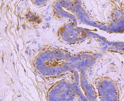 Immunohistochemistry-Paraffin: Ezrin Antibody (JM10-65) [NBP2-66827] - Analysis of paraffin-embedded human breast carcinoma tissue using anti-Ezrin antibody. Counter stained with hematoxylin.