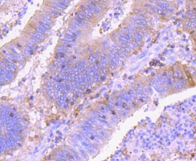 Immunohistochemistry-Paraffin: Ezrin Antibody (JM10-65) [NBP2-66827] - Analysis of paraffin-embedded human colon cancer tissue using anti-Ezrin antibody. Counter stained with hematoxylin.