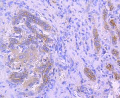 Immunohistochemistry-Paraffin: Ezrin Antibody (JM10-65) [NBP2-66827] - Analysis of paraffin-embedded human liver cancer tissue using anti-Ezrin antibody. Counter stained with hematoxylin.