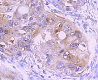 Immunohistochemistry-Paraffin: Ezrin Antibody (JM10-65) [NBP2-66827] - Analysis of paraffin-embedded human lung cancer tissue using anti-Ezrin antibody. Counter stained with hematoxylin.