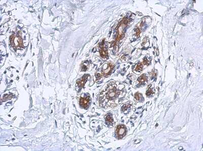 Immunohistochemistry-Paraffin: FAAH Antibody [NBP2-16397] - Immunohistochemical analysis of paraffin-embedded Breast ca, using antibody at 1:500 dilution.