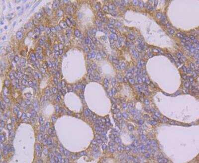 Immunohistochemistry: FAAH Antibody (JG43-07) [NBP2-76834] - Immunohistochemical analysis of paraffin-embedded human prostate cancer tissue using anti-FAAH1 antibody. Counter stained with hematoxylin.