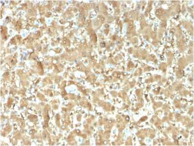 Immunohistochemistry-Paraffin: FABP1/L-FABP Antibody (FABP1/3482) [NBP3-08934] - Formalin-fixed, paraffin-embedded human Liver Carcinoma stained with FABP1/L-FABP Mouse Monoclonal Antibody (FABP1/L-FABP/3482).
