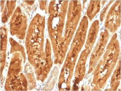 Immunohistochemistry-Paraffin: FABP1/L-FABP Antibody (FABP1/3487) [NBP3-08949] - Formalin-fixed, paraffin-embedded human liver carcinoma stained with FABP1/L-FABP Mouse Monoclonal Antibody (FABP1/L-FABP/3487).