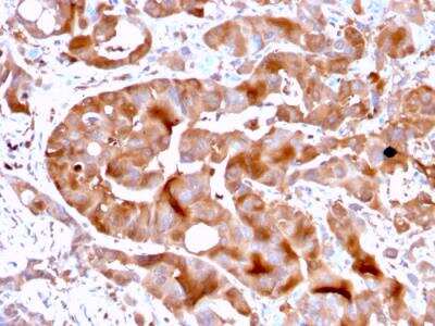 Immunohistochemistry-Paraffin: FABP5/E-FABP Antibody (FABP5/3750) - Azide and BSA Free [NBP2-79929] - Formalin-fixed, paraffin-embedded human Liver tissue stained with FABP5 Mouse Monoclonal Antibody (FABP5/3750).