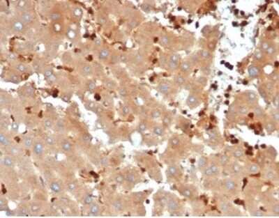 Immunohistochemistry-Paraffin: FABP5/E-FABP Antibody (FABP5/6353R) [NBP3-13882] - Formalin-fixed, paraffin-embedded human liver metastasized to colon stained with FABP5/E-FABP antibody (FABP5/6353R).