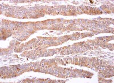 Immunohistochemistry-Paraffin: FABP6 Antibody [NBP1-32482] - Human colon carcinoma. ILBP antibody dilution: 1:500. Antigen Retrieval: Trilogy™ (EDTA based, pH 8.0) buffer, 15min. 