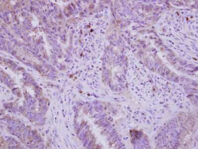 Immunohistochemistry-Paraffin: FADS1 Antibody [NBP2-16407] - Immunohistochemical analysis of paraffin-embedded Colon ca, using antibody at 1:250 dilution.