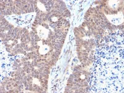 Immunohistochemistry-Paraffin: FAF1 Antibody (CPTC-FAF1-2) [NBP3-07506] - Formalin-fixed, paraffin-embedded human Colon Carcinoma stained with FAF1 Mouse Monoclonal Antibody (CPTC-FAF1-2).