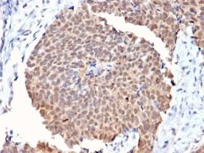 Immunohistochemistry-Paraffin: FAF1 Antibody (CPTC-FAF1-2) [NBP3-08227] - Formalin-fixed, paraffin-embedded human Breast Cancer stained with FAF1 Mouse Monoclonal Antibody (CPTC-FAF1-2).