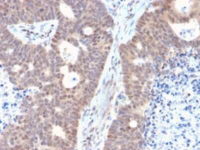 Immunohistochemistry-Paraffin: FAF1 Antibody (CPTC-FAF1-2) [NBP3-08227] - Formalin-fixed, paraffin-embedded human Colon Carcinoma stained with FAF1 Mouse Monoclonal Antibody (CPTC-FAF1-2).