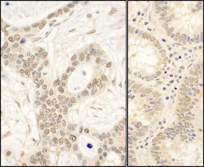 <b>Independent Antibodies Validation and Biological Strategies Validation.</b>Immunohistochemistry: FAF1 Antibody [NBP1-47276] - Sample: FFPE section of human ovarian carcinoma (left) and human colon carcinoma (right). Antibody: Affinity purified rabbit anti- FAF1 used at a dilution of 1:200 (1ug/ml). Detection: DAB