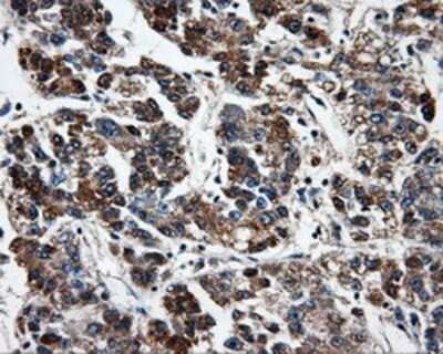 Immunohistochemistry: FAHD2A Antibody (OTI6D9) - Azide and BSA Free [NBP2-71886] - Staining of paraffin-embedded Carcinoma of liver tissue using anti-FAHD2A mouse monoclonal antibody.