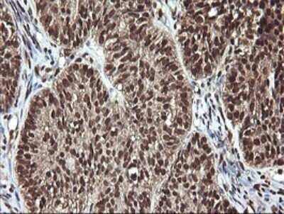 Immunohistochemistry: FAK Antibody (OTI4D11) - Azide and BSA Free [NBP2-71268] - Analysis of Adenocarcinoma of Human ovary tissue. (Heat-induced epitope retrieval by 10mM citric buffer, pH6.0, 120C for 3min)