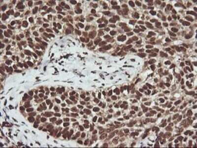 Immunohistochemistry: FAK Antibody (OTI4D11) - Azide and BSA Free [NBP2-71268] - Analysis of Carcinoma of Human lung tissue.(Heat-induced epitope retrieval by 10mM citric buffer, pH6.0, 120C for 3min)