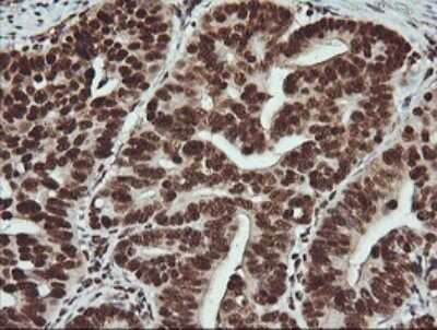 Immunohistochemistry: FAK Antibody (OTI4D11) - Azide and BSA Free [NBP2-71268] - Analysis of Carcinoma of Human pancreas tissue. (Heat-induced epitope retrieval by 10mM citric buffer, pH6.0, 120C for 3min)