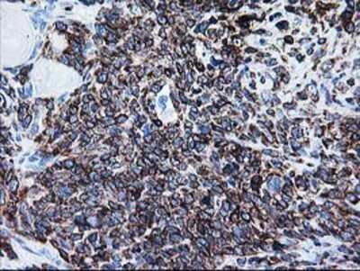 Immunohistochemistry: FALDH Antibody (OTI2A7) - Azide and BSA Free [NBP2-70159] - Staining of paraffin-embedded Adenocarcinoma of Human breast tissue using anti-FALDH mouse monoclonal antibody.