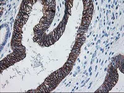 Immunohistochemistry: FALDH Antibody (OTI2A7) - Azide and BSA Free [NBP2-70159] - Staining of paraffin-embedded Adenocarcinoma of Human endometrium tissue using anti-FALDH mouse monoclonal antibody.
