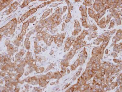 Immunohistochemistry-Paraffin: FAM120A Antibody [NBP2-16412] - Immunohistochemical analysis of paraffin-embedded Breast ca, using antibody at 1:250 dilution.