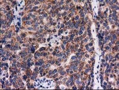 Immunohistochemistry: FAM127C Antibody (OTI1A6) - Azide and BSA Free [NBP2-71867] - Analysis of Adenocarcinoma of Human ovary tissue.