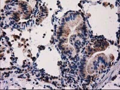 Immunohistochemistry: FAM127C Antibody (OTI1A6) - Azide and BSA Free [NBP2-71867] - Analysis of Carcinoma of Human lung tissue.