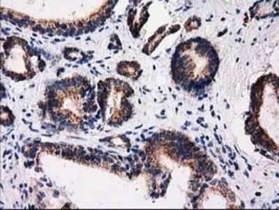 Immunohistochemistry: FAM127C Antibody (OTI1A6) - Azide and BSA Free [NBP2-71867] - Analysis of Carcinoma of Human prostate tissue.