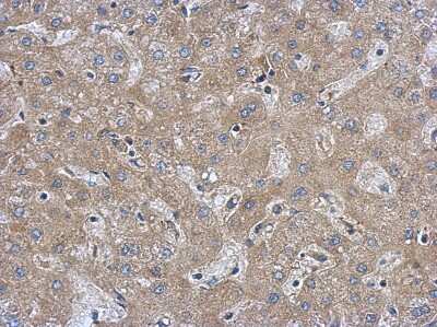 Immunohistochemistry-Paraffin: FAM171A1 Antibody [NBP2-16414] - Immunohistochemical analysis of paraffin-embedded Hepatoma, using antibody at 1:500 dilution.