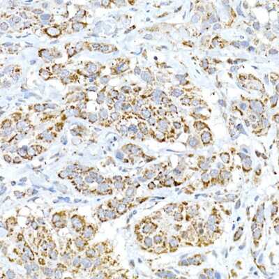 Immunohistochemistry-Paraffin: FAM3A Antibody [NBP3-16063] - Immunohistochemistry of paraffin-embedded human esophageal cancer using FAM3A Rabbit pAb (NBP3-16063) at dilution of 1:50 (40x lens).Perform high pressure antigen retrieval with 10 mM citrate buffer pH 6.0 before commencing with IHC staining protocol.